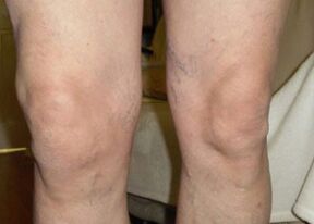 Vor der Anwendung von Osteflex waren Nils‘ Knie am Ende des Tages geschwollen. 